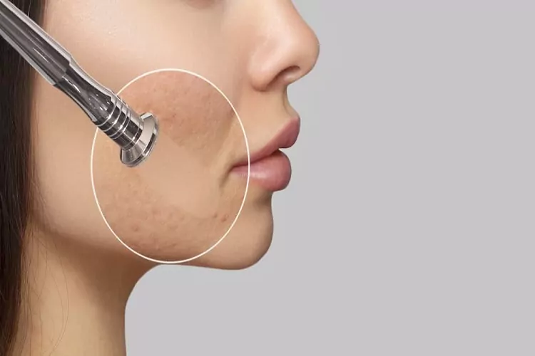 میکرودرم خوب است یا بد؟