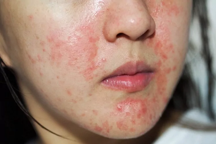 عوارض کرم موبر صورت