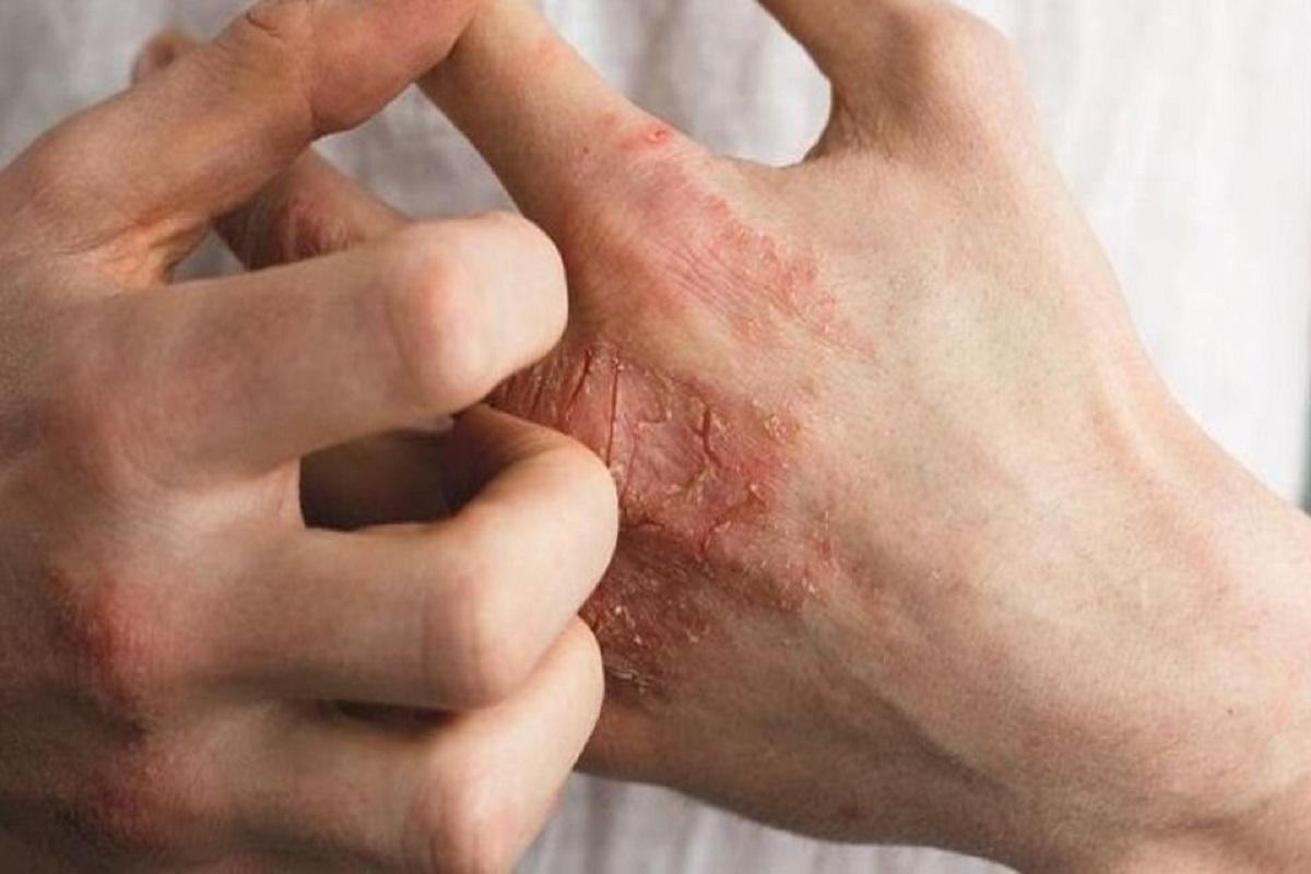 بیماری‌های پوستی (اگزما، پسوریازیس)
